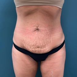 Tummy Tuck Before & After Patient #3696