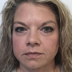 Fillers and Injectables Before & After Patient #3693