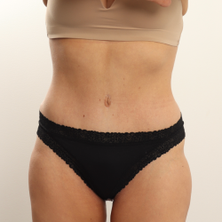 Tummy Tuck Before & After Patient #3696