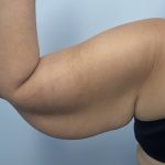 Arm Lift Before & After Patient #3754
