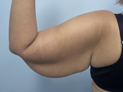 Arm Lift Before & After Patient #3754