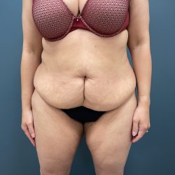 Tummy Tuck Before & After Patient #3771