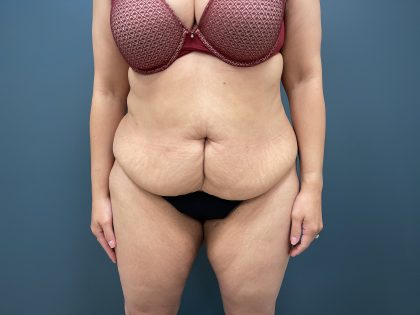 Tummy Tuck Before & After Patient #3771