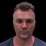NeoGraft Before & After Patient #3782