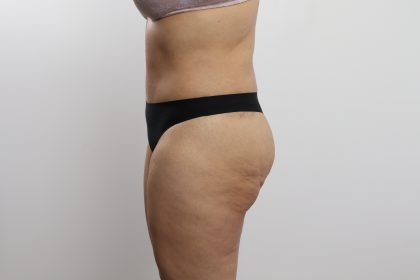 Tummy Tuck Before & After Patient #3771