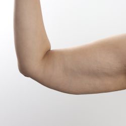 Arm Lift Before & After Patient #3754