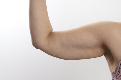 Arm Lift Before & After Patient #3754