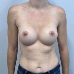 Breast Augmentation Before & After Patient #3743