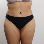 Tummy Tuck Before & After Patient #3771