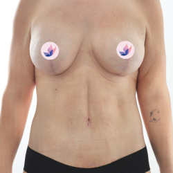 Breast Lift Before & After Patient #3797