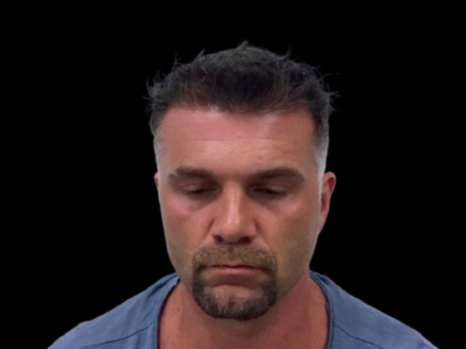 NeoGraft Before & After Patient #3782