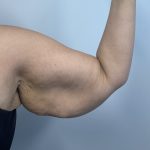 Arm Lift Before & After Patient #3754