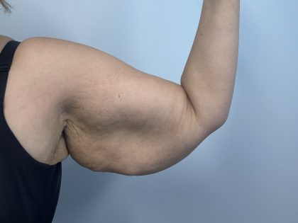 Arm Lift Before & After Patient #3754