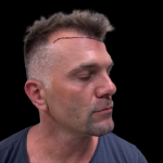 NeoGraft Before & After Patient #3782