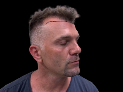 NeoGraft Before & After Patient #3782
