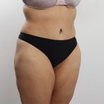 Tummy Tuck Before & After Patient #3771
