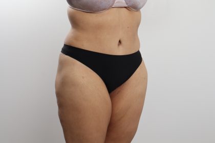 Tummy Tuck Before & After Patient #3771