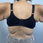 Arm Lift Before & After Patient #3754