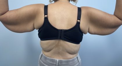 Arm Lift Before & After Patient #3754