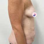 Lower Body Lift Before & After Patient #3797
