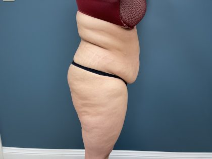 Tummy Tuck Before & After Patient #3771