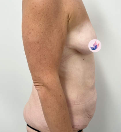 Lower Body Lift Before & After Patient #3797