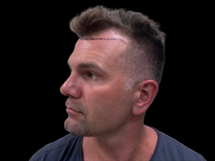 NeoGraft Before & After Patient #3782