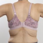 Arm Lift Before & After Patient #3754