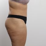 Tummy Tuck Before & After Patient #3771