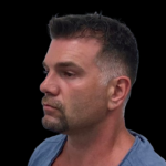 NeoGraft Before & After Patient #3782