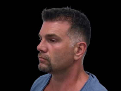 NeoGraft Before & After Patient #3782