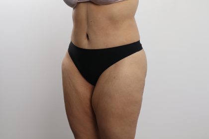 Tummy Tuck Before & After Patient #3771