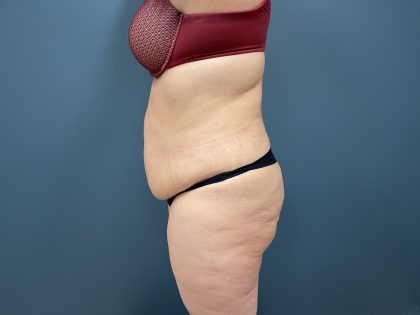 Tummy Tuck Before & After Patient #3771