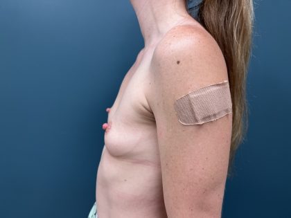 Breast Augmentation Before & After Patient #3743