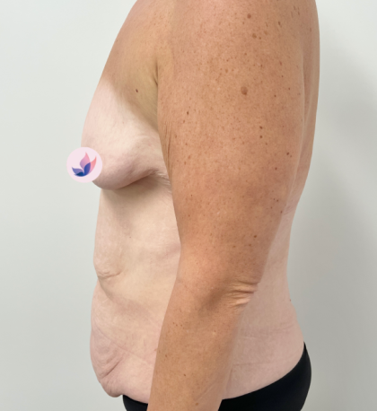 Lower Body Lift Before & After Patient #3797