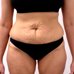 Tummy Tuck Before & After Patient #3820