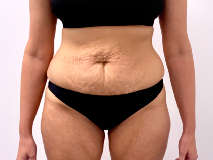 Tummy Tuck Before & After Patient #3820