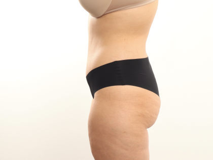 Tummy Tuck Before & After Patient #3820