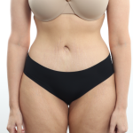 Tummy Tuck Before & After Patient #3820