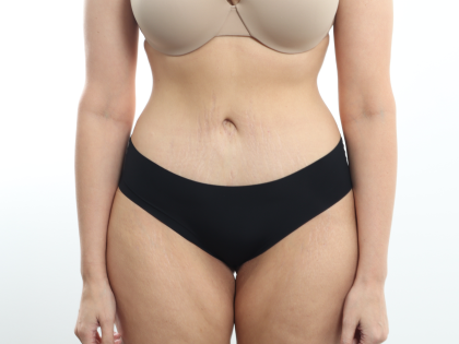 Tummy Tuck Before & After Patient #3820