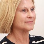 BroadBand Light Therapy (BBL) Before & After Patient #3849