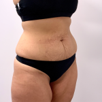 Tummy Tuck Before & After Patient #3820