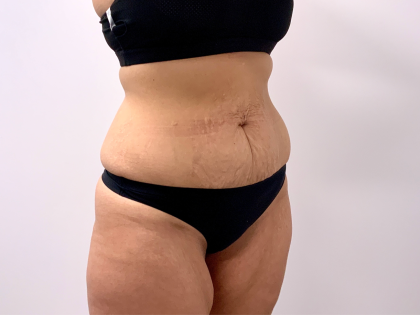 Tummy Tuck Before & After Patient #3820