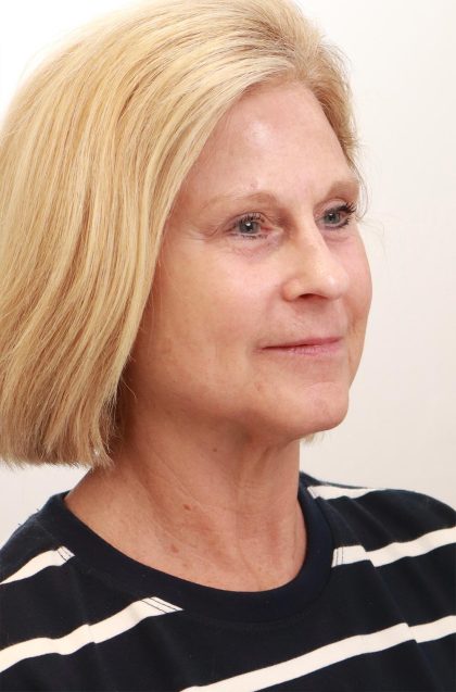 BroadBand Light Therapy (BBL) Before & After Patient #3849