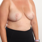 Breast Reduction Before & After Patient #3836