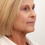 BroadBand Light Therapy (BBL) Before & After Patient #3849