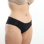Tummy Tuck Before & After Patient #3820