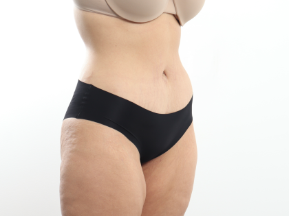 Tummy Tuck Before & After Patient #3820