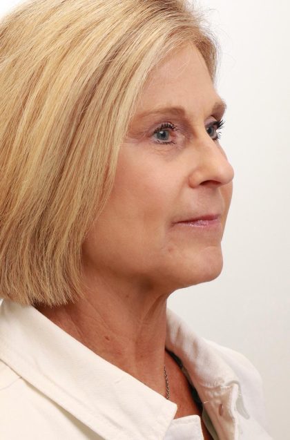 BroadBand Light Therapy (BBL) Before & After Patient #3849