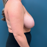 Breast Reduction Before & After Patient #3836